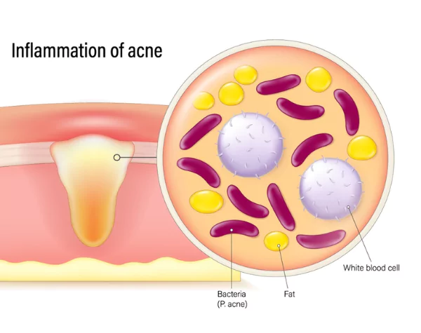 Cơ chế và nguyên nhân mụn trứng cá